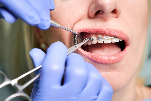 Wearing Bands On Your Braces