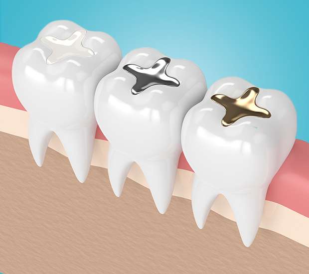 Foothill Ranch Tooth Colored Fillings