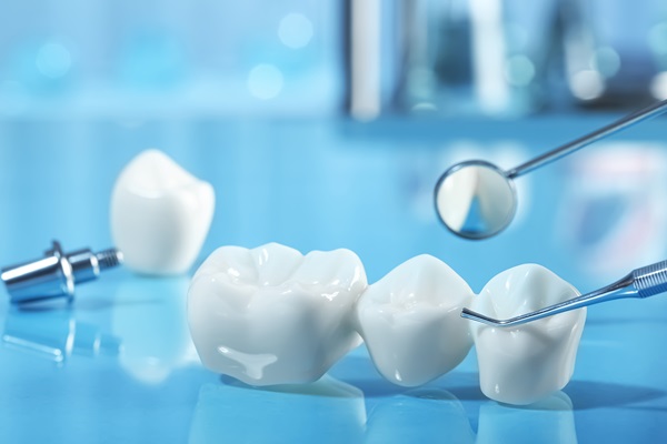 Benefits Of Dental Bridges