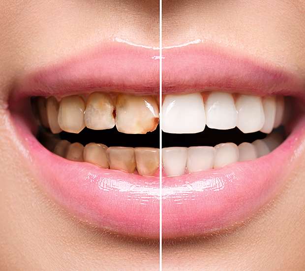Foothill Ranch Dental Implant Restoration