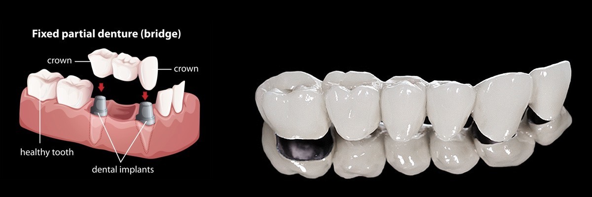 Foothill Ranch Dentures