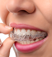 Clear Aligners - Almost Invisible Braces Foothill Ranch, CA