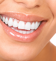 Teeth Whitening Services Foothill Ranch, CA