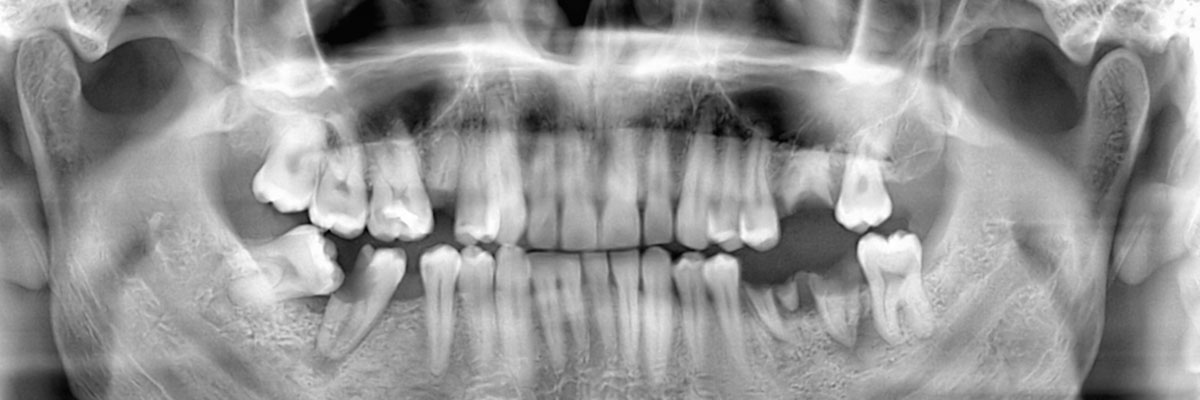 Foothill Ranch Wisdom Teeth Extraction